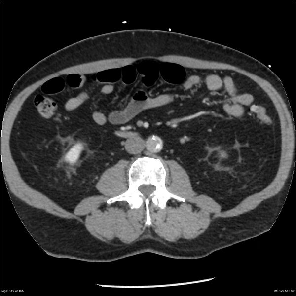 File:Aortic dissection- Stanford A (Radiopaedia 37759-39664 A 110).jpg