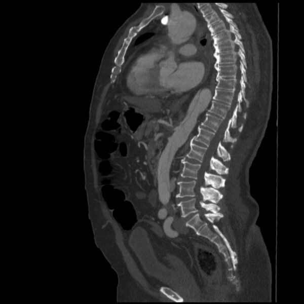 File:Aortic dissection (Radiopaedia 28802-29105 C 21).jpg