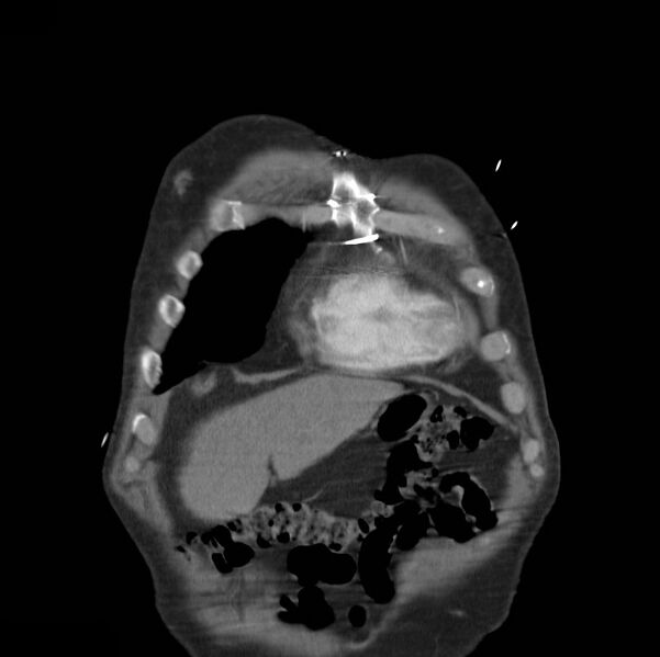 File:Aortic dissection with rupture into pericardium (Radiopaedia 12384-12647 B 2).jpg