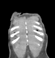 Aortic valve non-coronary cusp thrombus (Radiopaedia 55661-62189 C 76).png