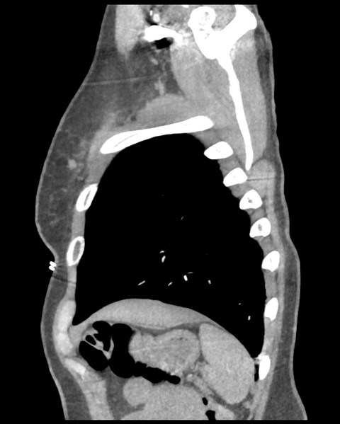 File:Aortic valve non-coronary cusp thrombus (Radiopaedia 55661-62189 D 9).png