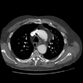 Aorto-coronary bypass graft aneurysms (Radiopaedia 40562-43157 A 35).png