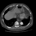 Aorto-coronary bypass graft aneurysms (Radiopaedia 40562-43157 A 97).png