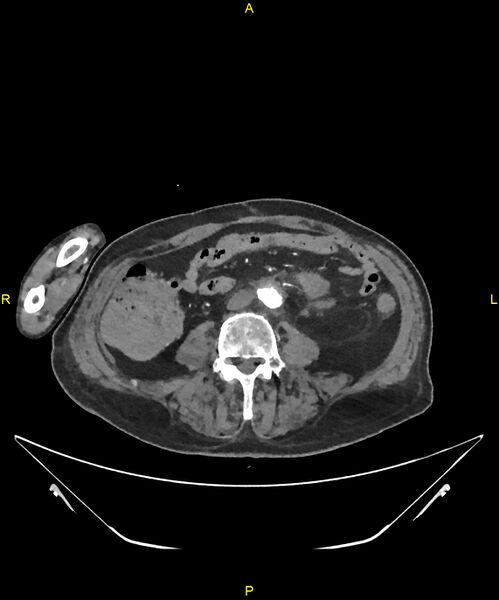 File:Aortoenteric fistula (Radiopaedia 84308-99603 B 221).jpg