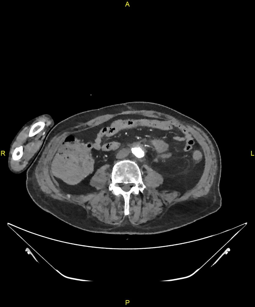 Aortoenteric fistula (Radiopaedia 84308-99603 B 221).jpg