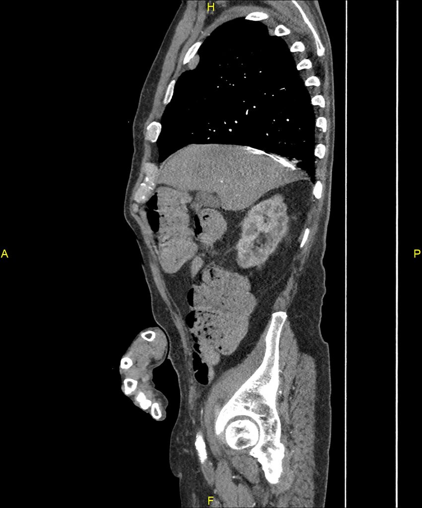 Aortoenteric fistula (Radiopaedia 84308-99603 C 90).jpg