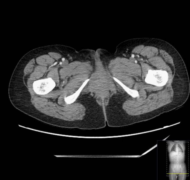 File:Appendicitis (CT angiogram) (Radiopaedia 154713-127660 Axial 108).jpg
