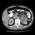 Appendicitis and renal cell carcinoma (Radiopaedia 17063-16760 A 19).jpg