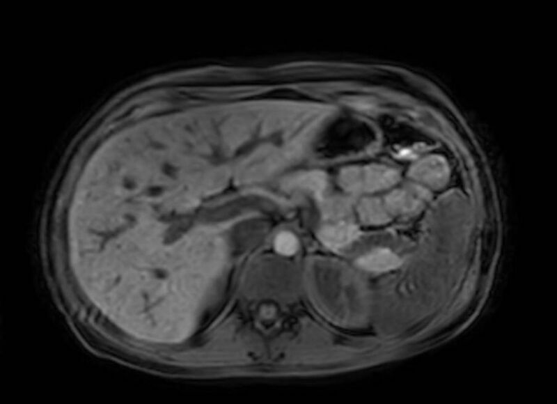 File:Appendicitis in gravida (MRI) (Radiopaedia 89433-106395 Axial DIXON 28).jpg