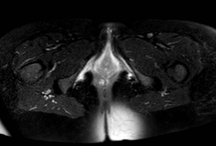 Appendicitis in gravida (MRI) (Radiopaedia 89433-106395 Axial T2 SPAIR 80).jpg