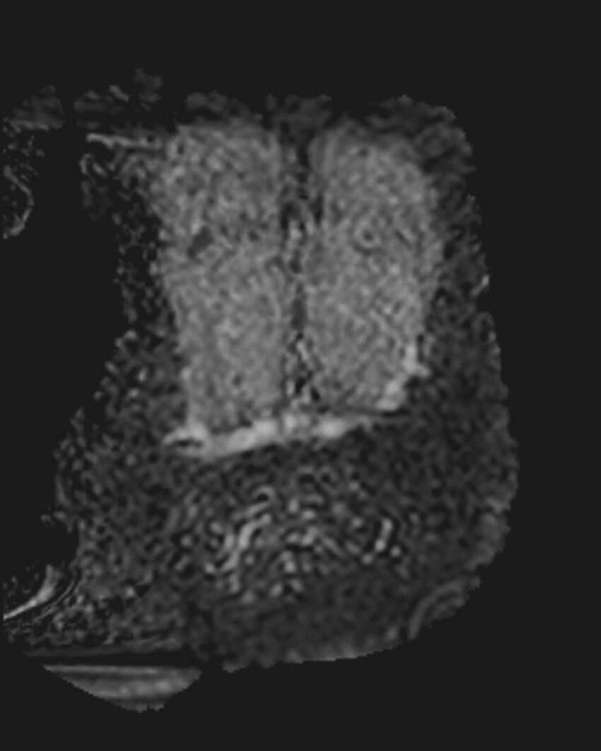 Appendicitis in gravida (MRI) (Radiopaedia 89433-106395 Coronal ADC 52).jpg