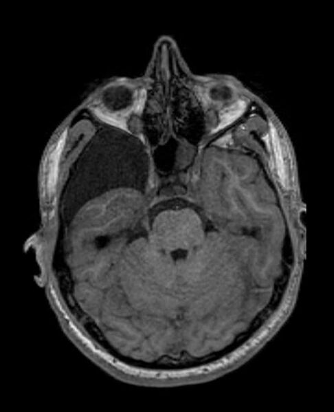 File:Arachnoid cyst- extremely large (Radiopaedia 68741-78451 Axial T1 24).jpg