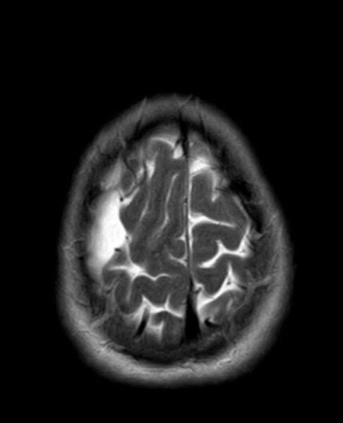 File:Arachnoid cyst- extremely large (Radiopaedia 68741-78451 Axial T2 24).jpg