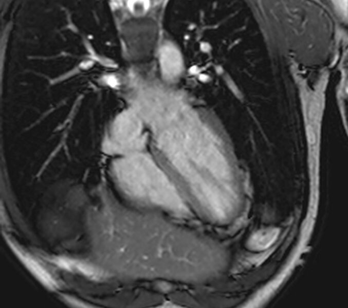 File:Arrhythmogenic right ventricular cardiomyopathy (Radiopaedia 39806-42237 D 108).jpg