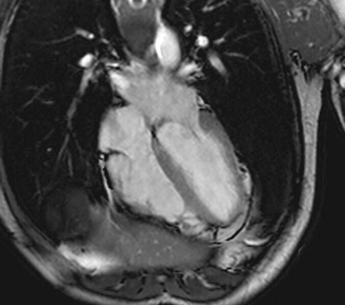 File:Arrhythmogenic right ventricular cardiomyopathy (Radiopaedia 39806-42237 D 76).jpg