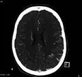 Arteriovenous malformation - cerebral (Radiopaedia 8172-14682 A 12).jpg