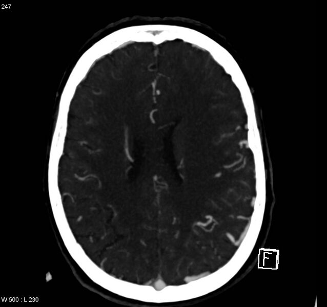 File:Arteriovenous malformation - cerebral (Radiopaedia 8172-14682 A 12).jpg