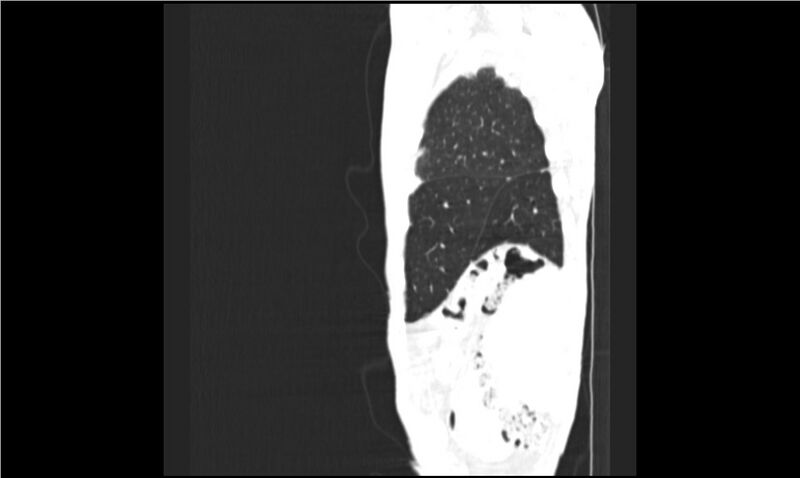 File:Aspergilloma (Radiopaedia 20788-20701 Sagittal lung window 19).jpg