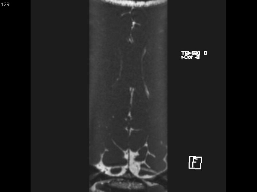Atypical meningioma - intraosseous (Radiopaedia 64915-74572 Axial CISS 129).jpg
