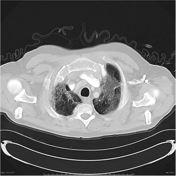 File:Atypical pneumonia - Q fever (Radiopaedia 21993-21989 lung window 4).jpg
