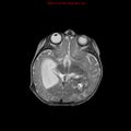 Atypical teratoid rhabdoid tumor (Radiopaedia 10712-11183 Axial T2 10).jpg