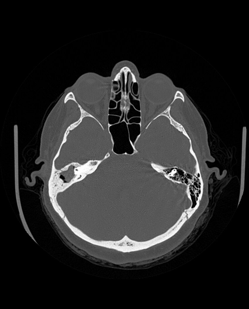 Automastoidectomy with labyrinthine fistula (Radiopaedia 84143-99411 Axial non-contrast 97).jpg