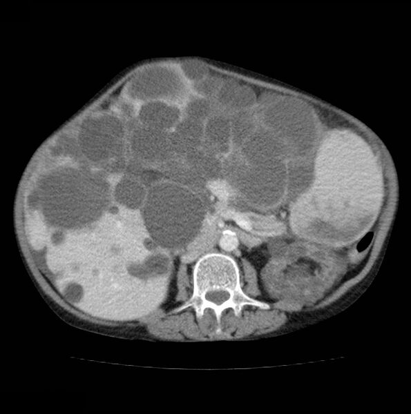 File:Autosomal dominant polycystic kidney disease (Radiopaedia 16777-16490 A 29).jpg