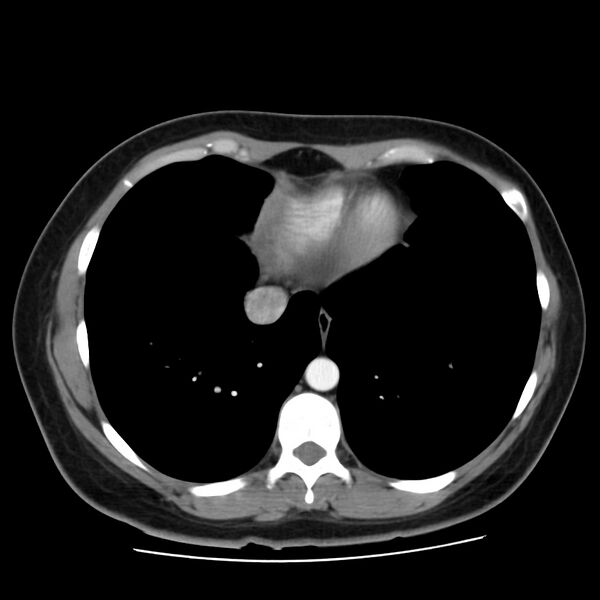 File:Autosomal dominant polycystic kidney disease (Radiopaedia 23061-23093 B 5).jpg