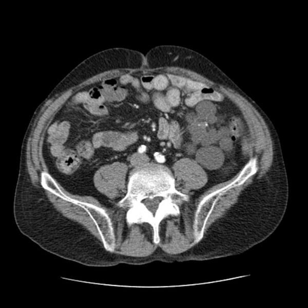 File:Autosomal dominant polycystic kidney disease (Radiopaedia 27851-28094 B 88).jpg