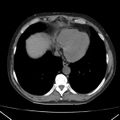 Autosomal dominant polycystic kidney disease (Radiopaedia 36539-38101 Axial non-contrast 5).jpg