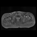 Avascular necrosis of the hip (Radiopaedia 29563-30067 Axial T1 C+ fat sat 11).jpg