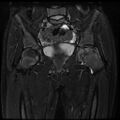 Avascular necrosis of the hip (Radiopaedia 29563-30067 Coronal T2 fat sat 7).jpg