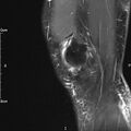 Avulsion fracture of the fibular head (Radiopaedia 74804-85808 Sagittal PD fat sat 5).jpg