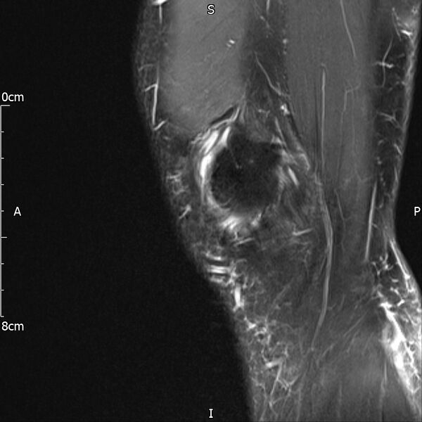 File:Avulsion fracture of the fibular head (Radiopaedia 74804-85808 Sagittal PD fat sat 5).jpg