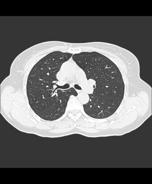 File:Azygos fissure and azygos lobe (Radiopaedia 41841-44832 Axial lung window 19).jpg