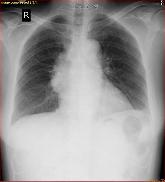 File:Azygos vein aneurysm (Radiopaedia 77824-90111 Upright AP 1).jpg