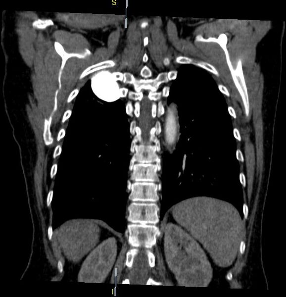 File:Azygos vein aneurysm (Radiopaedia 77824-90130 C 26).JPG