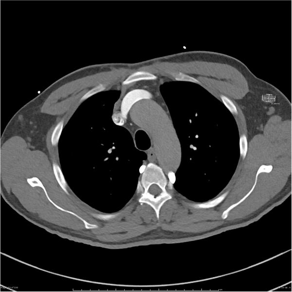 File:Azygos venous system anatomy (CT pulmonary angiography) (Radiopaedia 25928-26077 Axial C+ CTPA 23).jpg