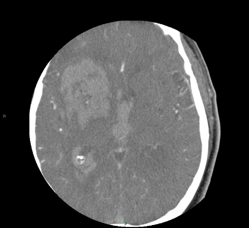 Basal ganglia hemorrhage (Radiopaedia 58763-65985 D 98).jpg