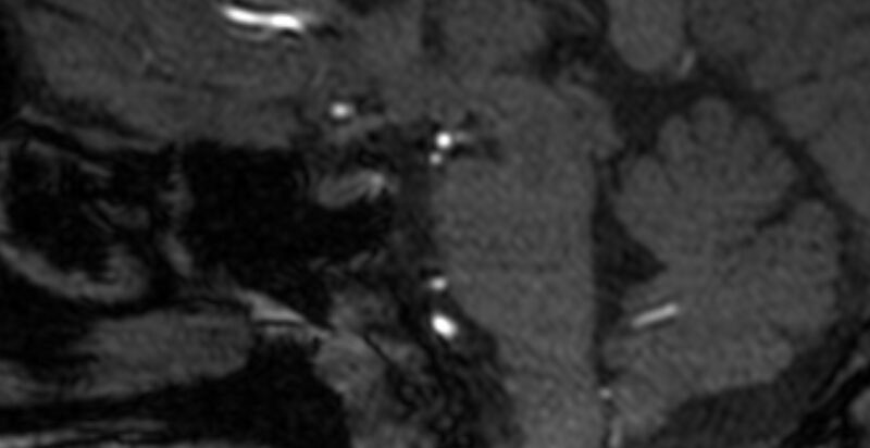 File:Basilar artery fenestration (Radiopaedia 74537-85455 Sagittal MRA TOF 24).jpg