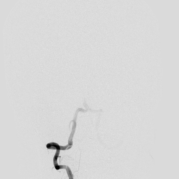 File:Basilar artery occlusion (Radiopaedia 33570-34668 RT VERT IC 10).png