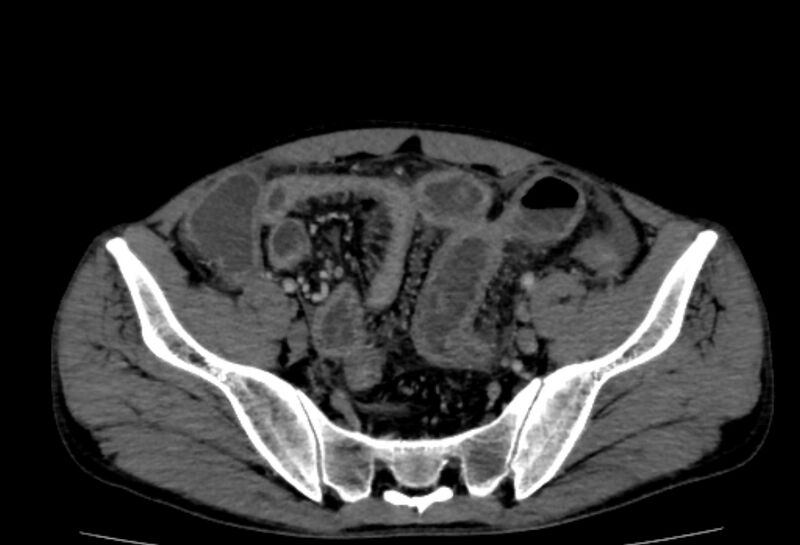 File:Behçet's disease- abdominal vasculitis (Radiopaedia 55955-62570 A 72).jpg