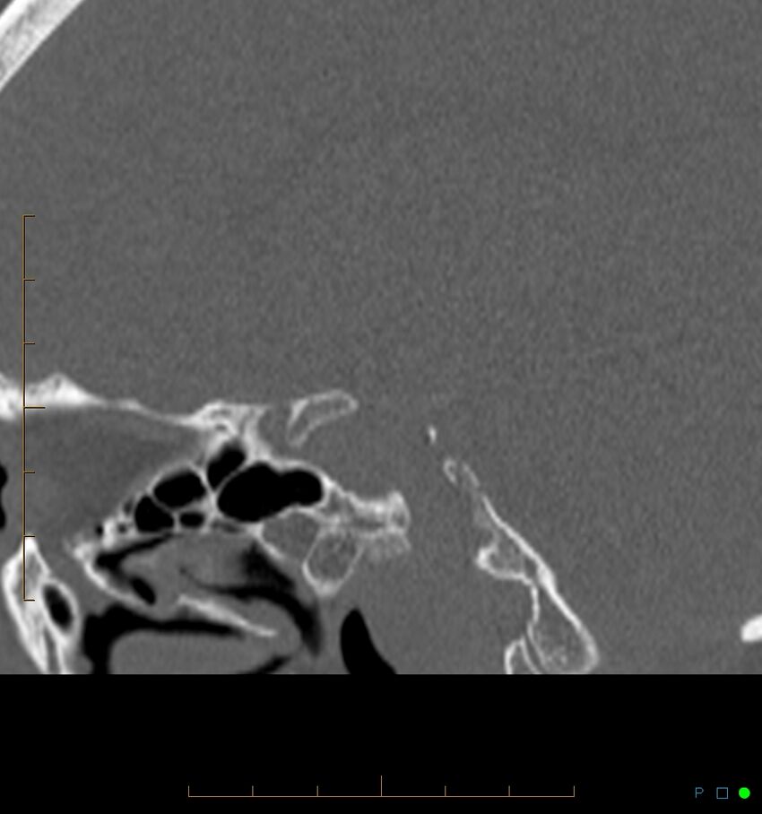 Benign notochordal cell tumor (probable) (Radiopaedia 65475-74546 Sagittal bone window 7).jpg