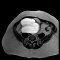 Benign seromucinous cystadenoma of the ovary (Radiopaedia 71065-81300 B 16).jpg