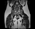 Bicornuate bicollis uterus (Radiopaedia 61626-69616 Coronal T2 26).jpg