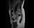 Bicornuate bicollis uterus (Radiopaedia 61626-69616 Sagittal T2 29).jpg