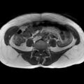 Bicornuate uterus (Radiopaedia 61974-70046 Axial T1 10).jpg