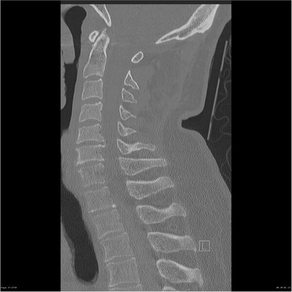 File:Bilateral cervical ribs (Radiopaedia 25868-26017 Sagittal bone window 37).jpg