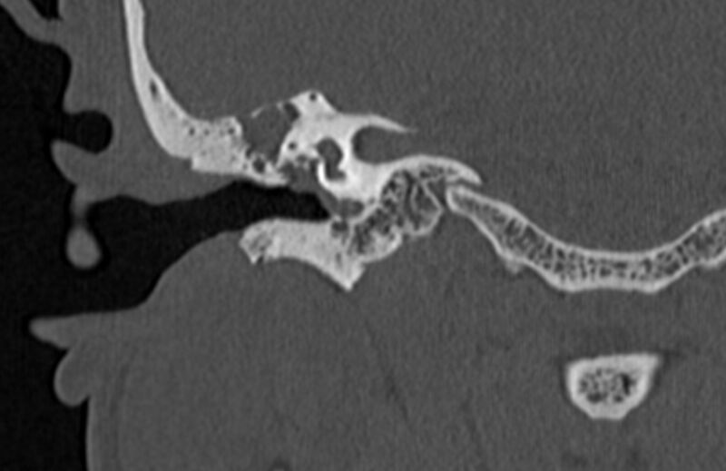 File:Bilateral cholesteatoma (Radiopaedia 54898-61172 Coronal bone window 40).jpg