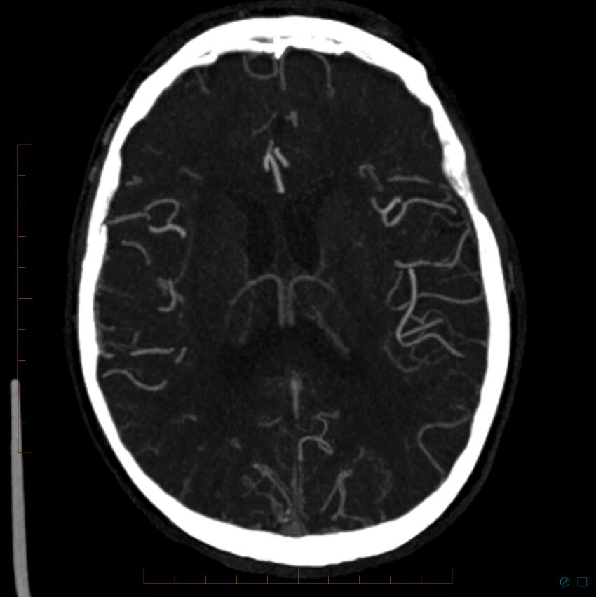 Bilateral chronic common carotid occlusion (Radiopaedia 50849-56362 D 13).jpg